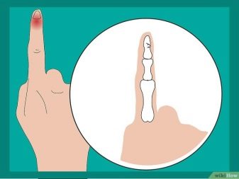 Матрикс нігтя (18 фото): що це таке? Як лікувати пошкоджену зону?