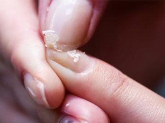 Матрикс нігтя (18 фото): що це таке? Як лікувати пошкоджену зону?