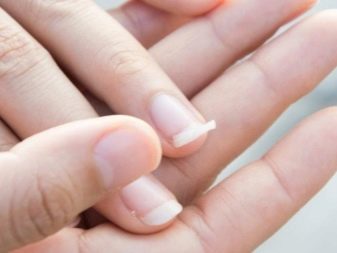 Матрикс нігтя (18 фото): що це таке? Як лікувати пошкоджену зону?