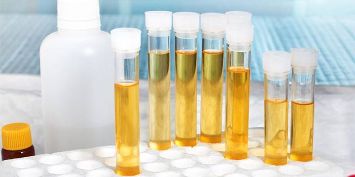 Аналіз сечі на ацетон — значення норми для дитини і дорослого, причини підвищеного рівня і лікування