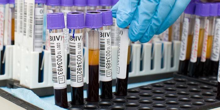 Білірубін у крові — таблиця норми для дітей і дорослих. Причини підвищеного білірубіну в крові і як знизити