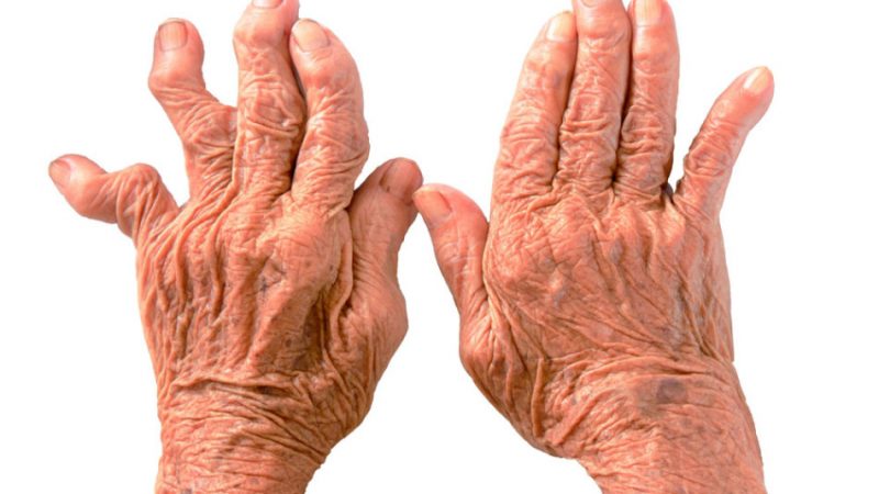 Болить суглоб великого пальця на руці: причини, лікування. Що робити, якщо болить суглоб великого пальця на руці?