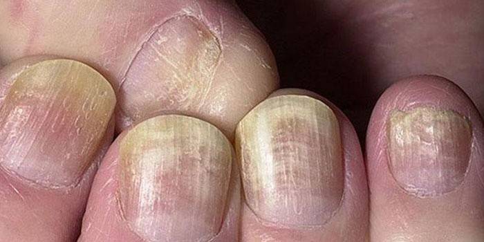 Чим лікувати грибок нігтів на руках: ефективні препарати та народні засоби