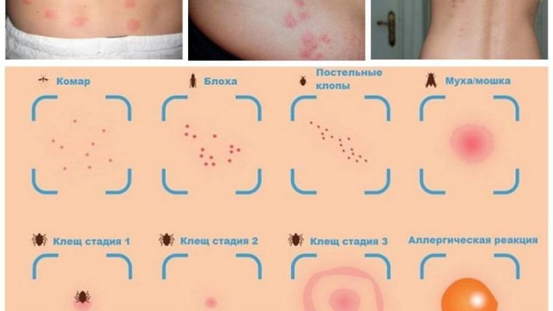 Чим відрізняються укуси клопів від укусів комарів? Як дізнатися, яка комаха вкусила? Фотографії укусів комах