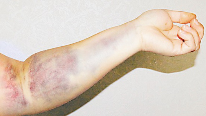 Чому після здачі крові залишаються синці і що з цим робити