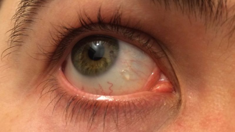 Чому виникають бульбашки на століттях під віями, на очному яблуці: причини появи, способи лікування, огляд препаратів та народні рецепти