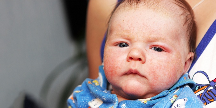 Діатез у новонароджених на обличчі: симптоми, причини і лікування