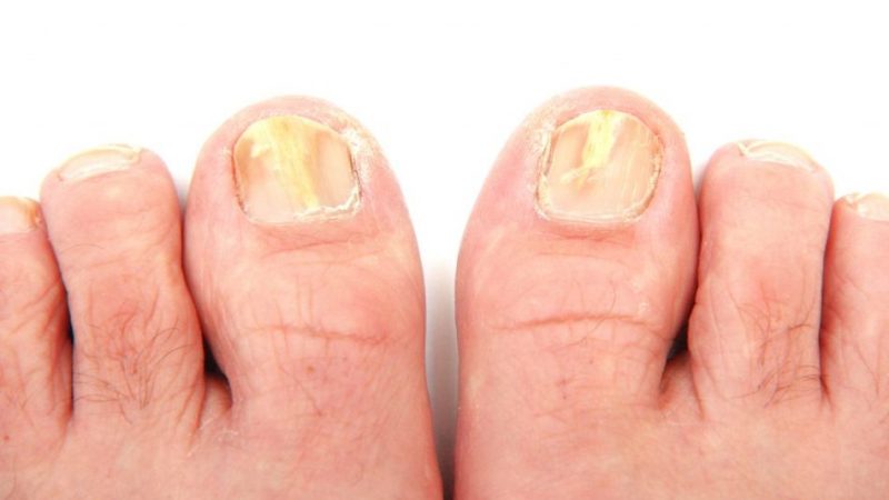 Деформація нігтів на руках і ногах: причини і лікування. Про що говорить деформація нігтя на великому пальці і мізинці ноги і руки?