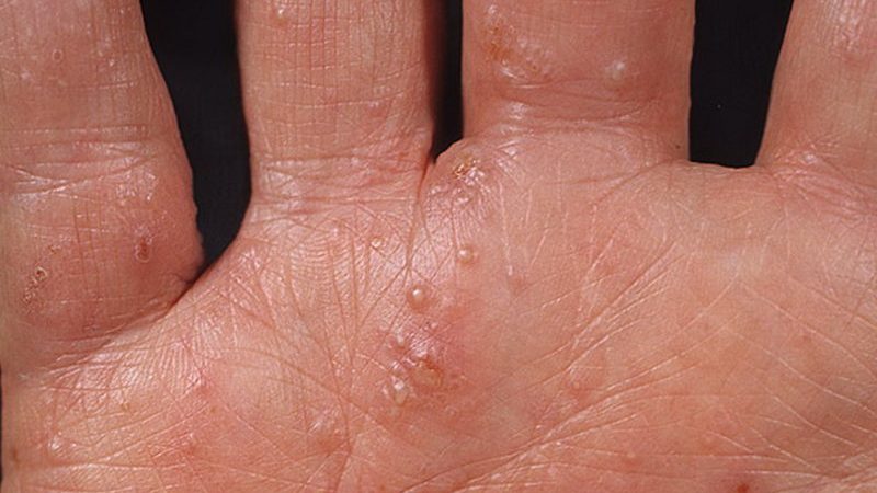 Дисгідрозі кистей рук і стоп ніг: причини, симптоми, лікування. Мазі, ванночки і народні засоби для лікування дисгидротической екземи