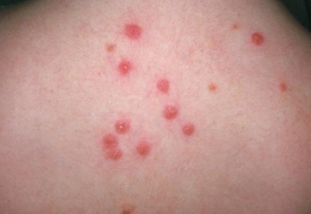 Дитину покусали блохи: що робити, як лікувати