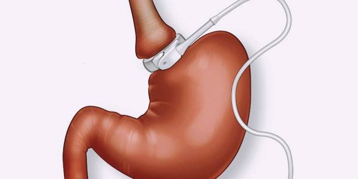 Екстремальне схуднення — програми швидкого перетворення