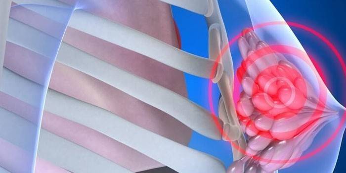 Фіброзно-кістозна мастопатія молочної залози: лікування