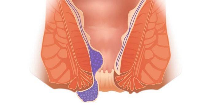 Геморой при вагітності: лікування