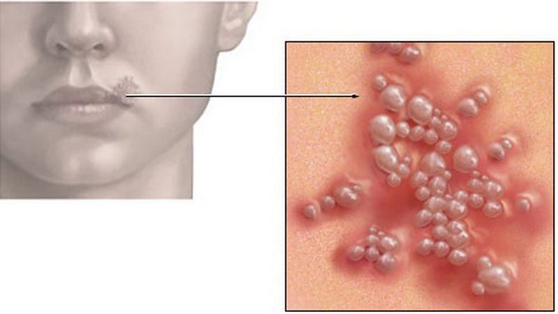 Герпес на губах під час вагітності: небезпека, наслідки, лікування. Причини герпесу на губах у 1, 2 і 3 триместрі вагітності