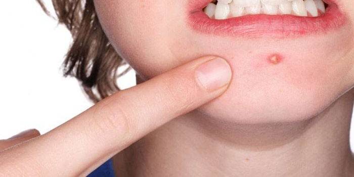 Глисти у калі у дітей і дорослих — шляхи зараження, симптоми, види паразитів, діагностика і лікування