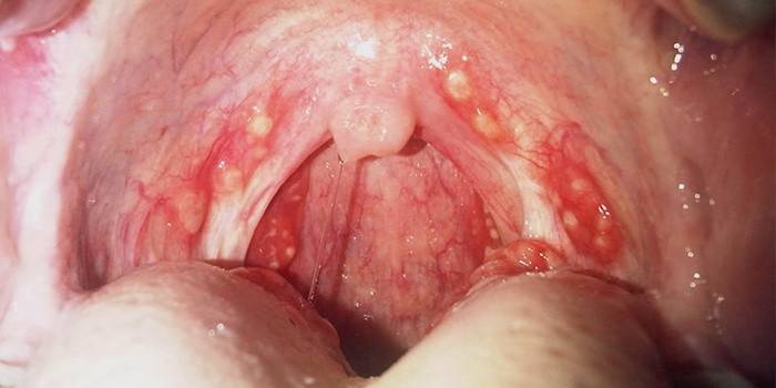 Гній на стінках горла