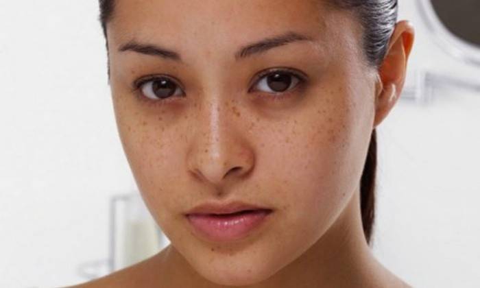 Круги під очима: причини появи і як прибрати