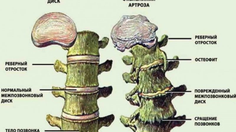 Лікування суглобів та остеохондроз хребта харчовою содою: компреси. Харчова сода від болю в суглобах: як пити?