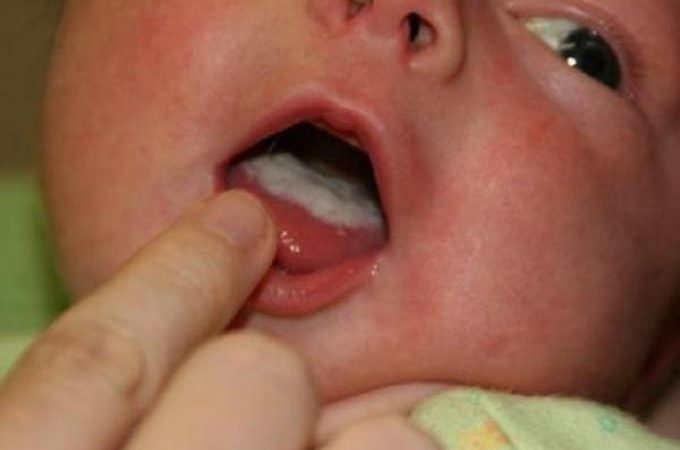 Молочниця у дітей, немовлят і новонароджених у роті мовою: фото, симптоми, причини, діагностика, лікування препаратами і народними засобами, профілактика