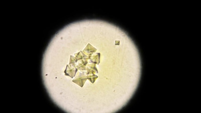 Оксалати в сечі: що це значить? Причини появи оксалатів у сечі у дитини і дорослого. Як позбутися від оксалатів у сечі?