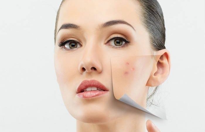 Підшкірні прищі