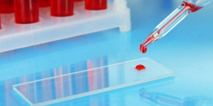 Підвищена ШОЕ в аналізі крові — що це значить. Причини підвищення показника ШОЕ у дітей, вагітних та дорослих