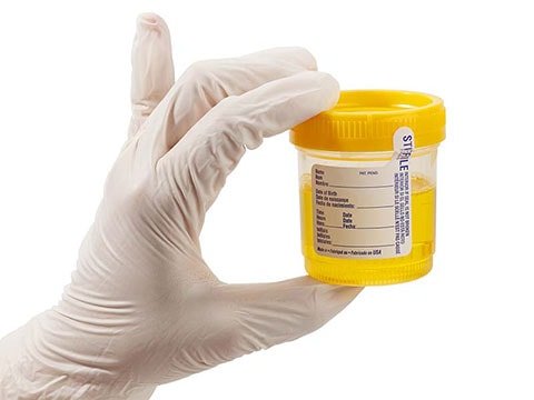 Підвищений білок у сечі при вагітності: причини і лікування