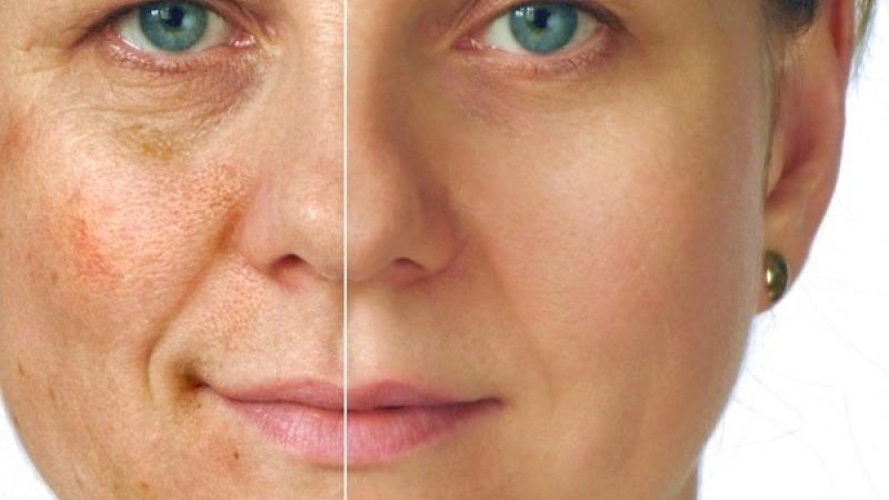 Пігментні плями на обличчі — як замаскувати? Чому з'являються пігментні плями на обличчі і як від них позбутися?
