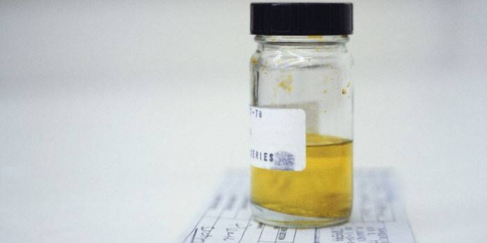 Пісок в нирках — симптоми у чоловіків і жінок, як вивести мікроліти з нирок