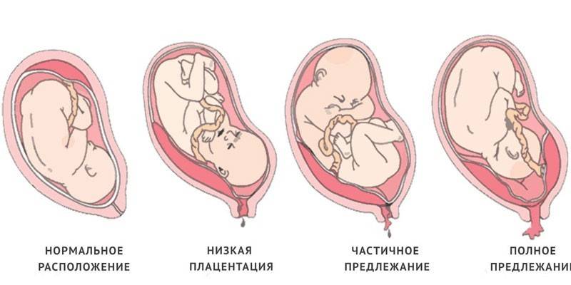 Плацента по передній стінці — правильне передлежання і причини відхилень, діагностика і небезпечні ускладнення