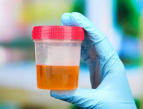 Поширені причини темного кольору сечі у чоловіків