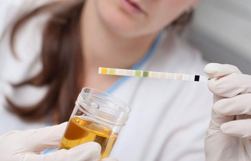 Поширені причини темного кольору сечі у чоловіків Поширені причини темного кольору сечі у чоловіків