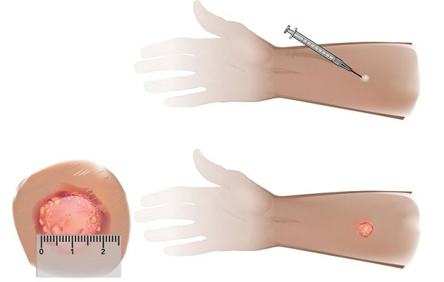 Реакція на манту у дитини: як повинна виглядати в нормі? Реакція на манту у дитини: як повинна виглядати в нормі?