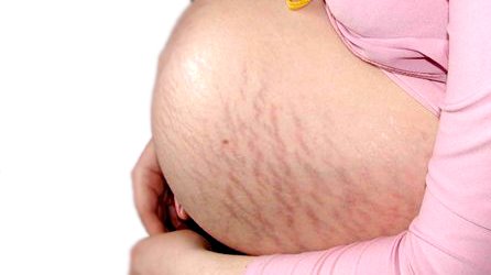 Розтяжки при вагітності як їх уникнути? Чому і коли з’являються розтяжки?