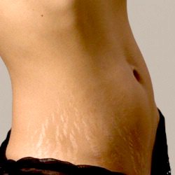 Розтяжки при вагітності як їх уникнути? Чому і коли з’являються розтяжки?