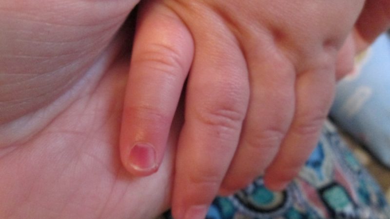 Що робити якщо прищемив палець посинів ніготь? Дитина прищемив палець дверима, що робити? Перша допомога та народні рецепти при ударі пальця