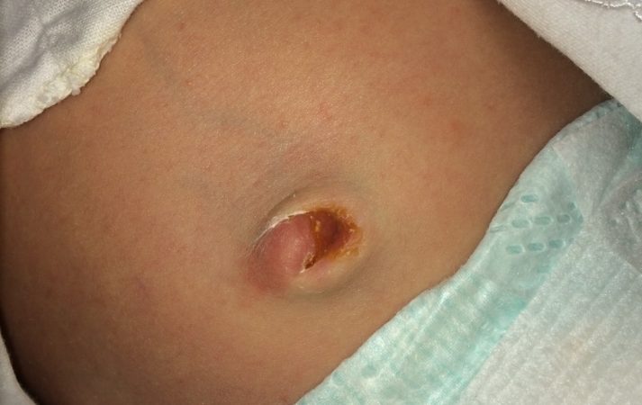Що таке пупковий свищ у новонароджених, дітей і дорослих, як виглядає, як лікувати? Як зробити обстеження пупка у новонародженого на свищі?