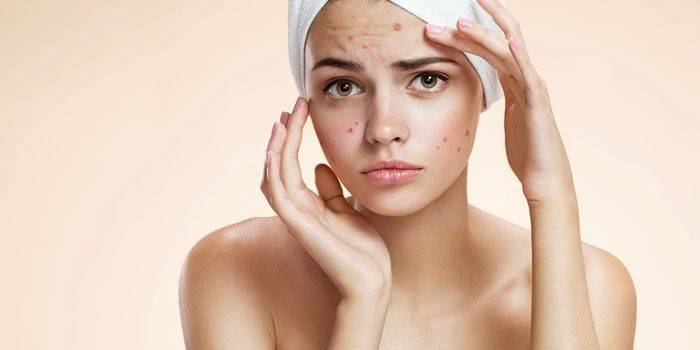 Що таке вітрянка у дітей і дорослих. Перші ознаки, симптоми і терміни лікування вітряної віспи