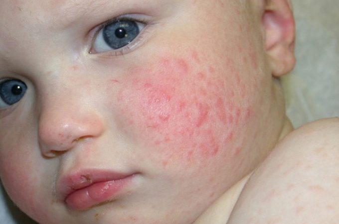 Що таке золотуха у дорослих і дітей за вухами: симптоми, ознаки, причини, лікування. Як лікувати золотуху у дорослих і немовлят?