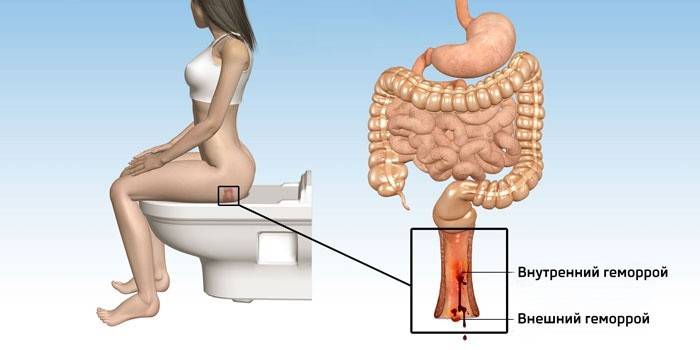 Шишка в задньому проході — причини і лікування у жінок і чоловіків