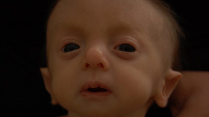 Синдром Патау у дітей: каріотип, симптоми, ознаки, причини, лікування, фото новонароджених. Синдром Патау діагностика: біохімічний скринінг, УЗД