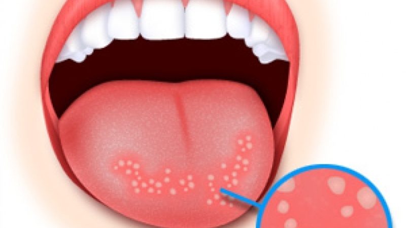 Стоматит у дорослих.Симптоми захворювання. Препарати і лікування народними засобами.