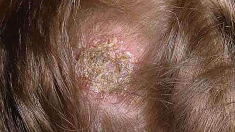 Стригучий лишай у дитини на голові: симптоми, причини, способи лікування