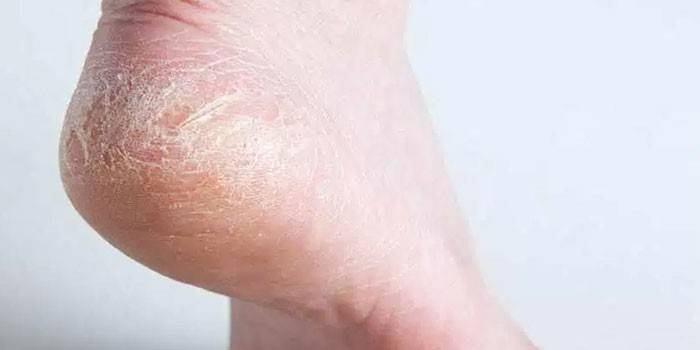 Суха шкіра на руках і ногах — причини і лікування