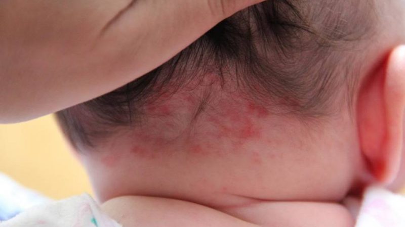 Укус лелеки — родима пляма у новонародженого: народні прикмети. Укус лелеки — що робити?