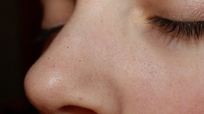 Від чого з'являються чорні крапки на обличчі: причини. Способи боротьби з чорними крапками на обличчі: народні рецепти, поради