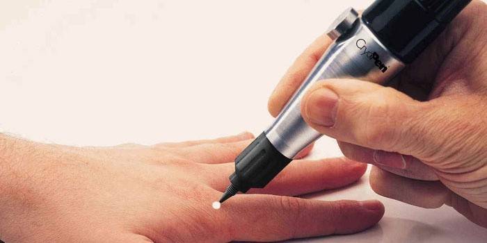 Видалення бородавок рідким азотом