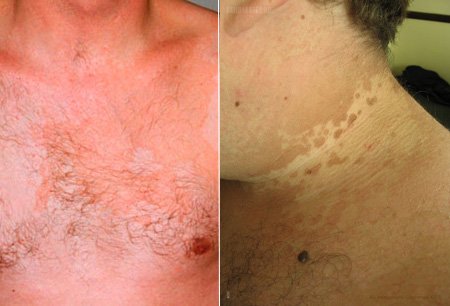 Висівкоподібний лишай: фото, причини, симптоми і лікування цієї хвороби Висівкоподібний лишай: фото, причини, симптоми і лікування цієї хвороби