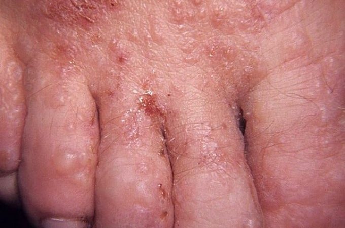 Водянисті пухирці на шкірі: причини, симптоми, діагностика, лікування, профілактика