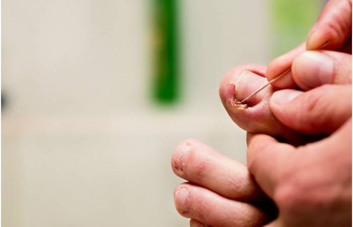 Врослий ніготь на великому пальці ноги — лікування